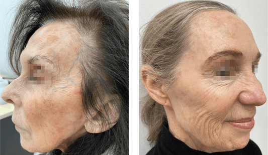 Problèmes de Peau et Ménopause